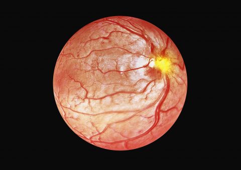 Superluminescent Laser Diodes - Optical Coherence Tomography