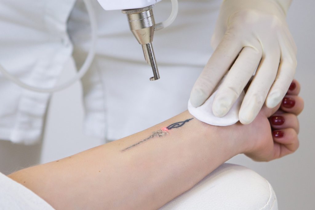 Lasers For Tattoo Removal