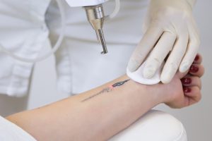 laser tattoo removal - technician and patient receiving service