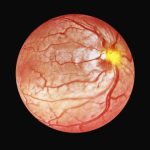 optical coherence tomography (OCT) laser application