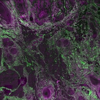 MULTI-PHOTON - Unstained cryosection of cancerous human breast tissue (4800 µm) - overlay of SHG-515 nm (green) and 2P-542 nm (red).
