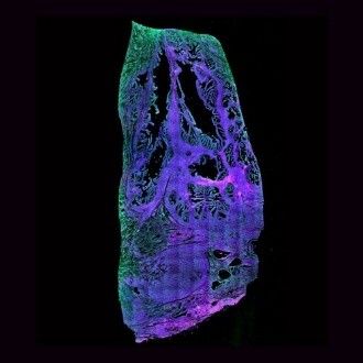 WIDEFIELD - Stitched image of unstained cryosection of cancerous human prostate tissue 816x, 0.8 NA, 5000 x 11700 µm) - overlay of 395 nm (magenta), 475 nm (blue) and 555 nm (green).